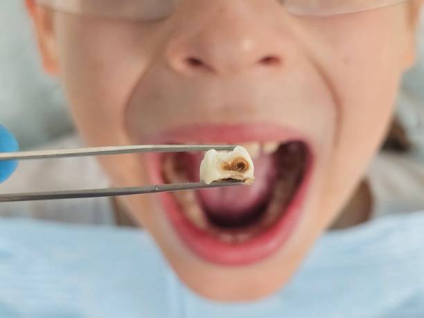 Best Emergency Dental Care for Abscessed Tooth in Bacliff, TX